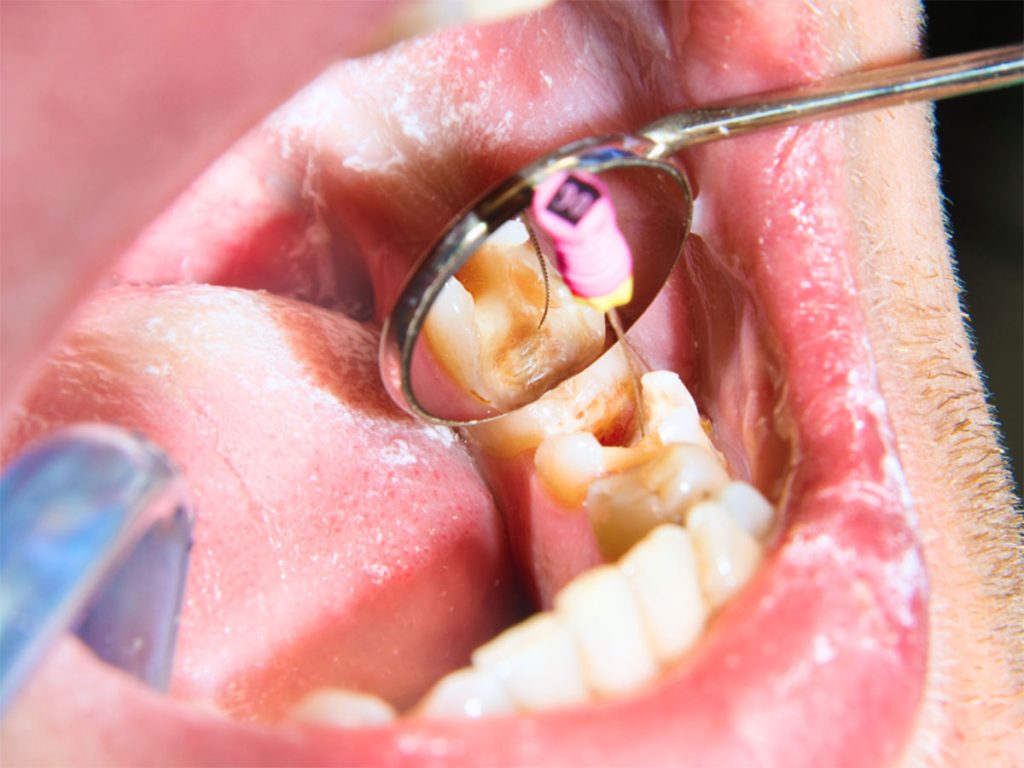 Understanding root canal lifespan and importance of post-treatment care. Tooth Pain & Sensitivity