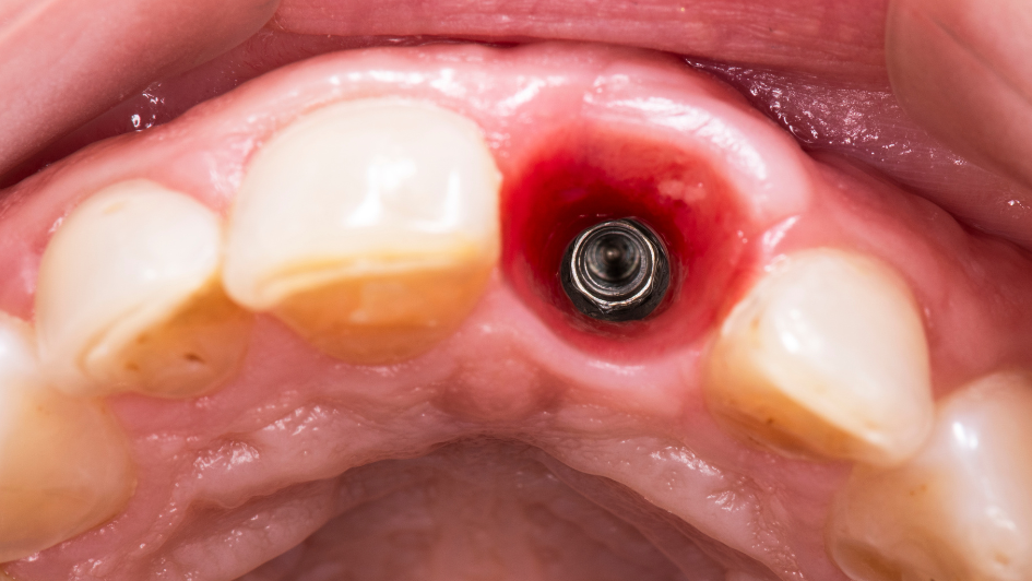 Dental Implant Candidates